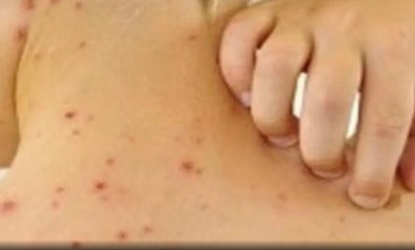 Beja registra 3 casos de sarampo e monitora mais de 500 contatos