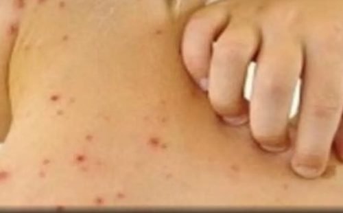 Beja registra 3 casos de sarampo e monitora mais de 500 contatos